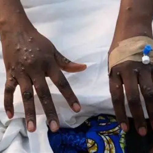 SUVISA atualiza os casos Mpox na Bahia